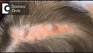 What causes Sebaceous Cyst on the scalp? - Dr. Nischal K