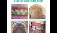 Vertical/ Deepbite/ Overbite Correction in Adults