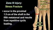 Proximal Fifth Metatarsal Fractures - Everything You Need To Know - Dr. Nabil Ebraheim