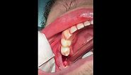 How to pull a broken tooth - First Molar extraction - قلع جراحي