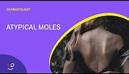 Atypical Moles - What Are They? [Dermatology] (2018)