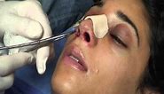 The Kotler Nasal Airway - Removal of the Airway