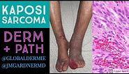 Kaposi Sarcoma: Dermatology/Pathology Collaboration by @globaldermie & @JMGardnerMD