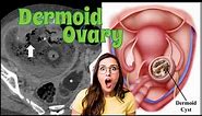 Dermoid Ovarian Cyst || Atypical Radiology || CECT THORAX AND WHOLE ABDOMEN