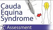 Cauda Equina Syndrome | Signs & Symptoms