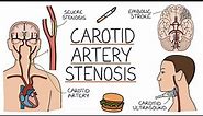 Understanding Carotid Artery Stenosis