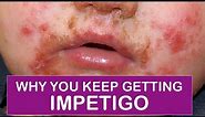 What You and Your Doctor Should Be Doing To Stop Getting Impetigo