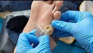 Pedicure Tutorial: How to treat plantar wart. Plantar wart removal. Two warts on the sole.