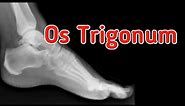 Os Trigonum and Os Trigonum Syndrome