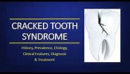 Cracked Tooth Syndrome: Symptoms, Diagnosis & Treatment