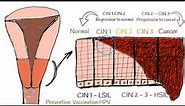 CIN - Cervical intraepithelial neoplasia (cervical dysplasia). CIN I; CIN II; CIN III explained