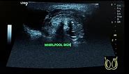 testicular torsion ultrasound - whirlpool sign