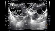 Ultrasound Video showing Three types of Cysts in the same patient.