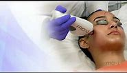 Moxi Laser Treatment - Maffi Clinics