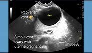 Simple cyst of ovary with early pregnancy, transvaginal ultrasound video