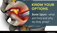 What are bone spurs and why do they grow? - Spine Surgery