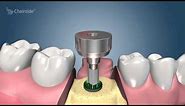Dental Implant Procedure - Two Stage 🦷 Award Winning Patient Education