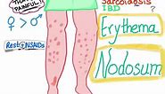 Erythema Nodosum