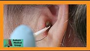 Chunky Earwax Removal | Auburn Medical Group