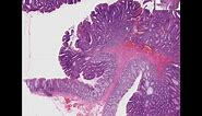 Histopathology Colon --Tubular adenoma (adenomatous polyp)