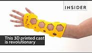 This 3D printed cast is revolutionizing how we heal broken bones