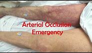 Acute, Complete Occlusion of the Leg Arteries