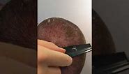 Scalp burn peeling