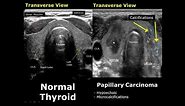 Thyroid Ultrasound Normal Vs Abnormal Image Appearances Comparison | Thyroid Pathologies USG
