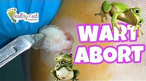 WOW! HUGE WART REMOVED FROM HEEL!