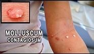 UNUSUAL MOLLUSCUM CONTAGIOSUM (Treated with Cryotherapy) | Dr. Paul