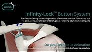 Infinity-Lock™ Button System Surgical Technique Animation