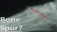 Bone Spur on Top of the Foot [Treatment for Bumps & Lumps!]