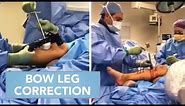 Bow Leg Correction Procedure | Inside the OR with Dr. Mahboubian