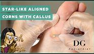 Star-like aligned corns with callus