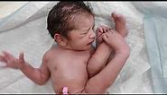 Newborn baby with flexible feet due to breech delivery