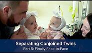 Separating Conjoined Twins Part 5: Finally Face-to-Face