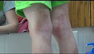 Mayo Clinic Minute - Atopic dermatitis triggers