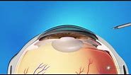 What is Refractive Lens Exchange Surgery?
