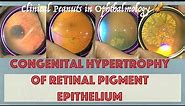 CHRPE - Congenital Hypertrophy of Retinal Pigment Epithelium : Video atlas