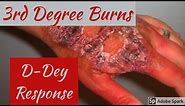 How to deal with 3rd Degree Burns