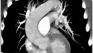 4D Imaging of the Aortic Valve: Dilated aortic root (1 of 6)