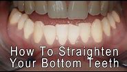 Dental Braces - How to Straighten your bottom front teeth