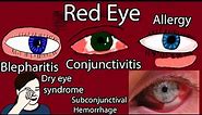 Red Eye Causes, Symptoms and Treatment. Pink eye causes