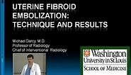 Uterine Fibroid Embolization: Technique and Results