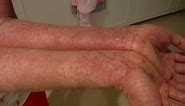 Treatment of eczema and other skin diseases