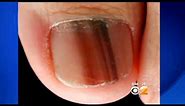 Doctors Warn Of Potentiall Deadly Form Of Nail Cancer
