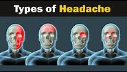 Headache - Types and causes | 3d Animation
