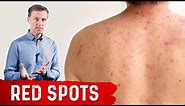 Why Red Spots on My Skin – Dr.Berg on Skin Red Spots Causes & Remedies