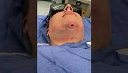 Smartlipo laser treatment and liposuction to chin - video includes fat aspiration
