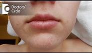 What causes acne around the mouth? - Dr. Aruna Prasad